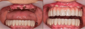 Dental Implants
