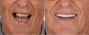 Dental Treatment Before & After